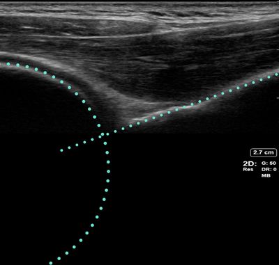 posterior shoulder dislocation w/ guides