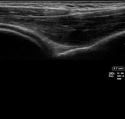 posterior shoulder dislocation