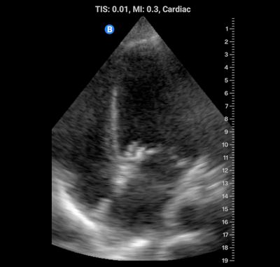 endocarditis