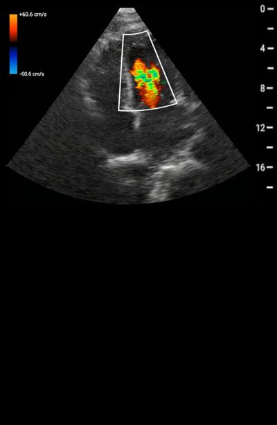 Color Doppler Flow